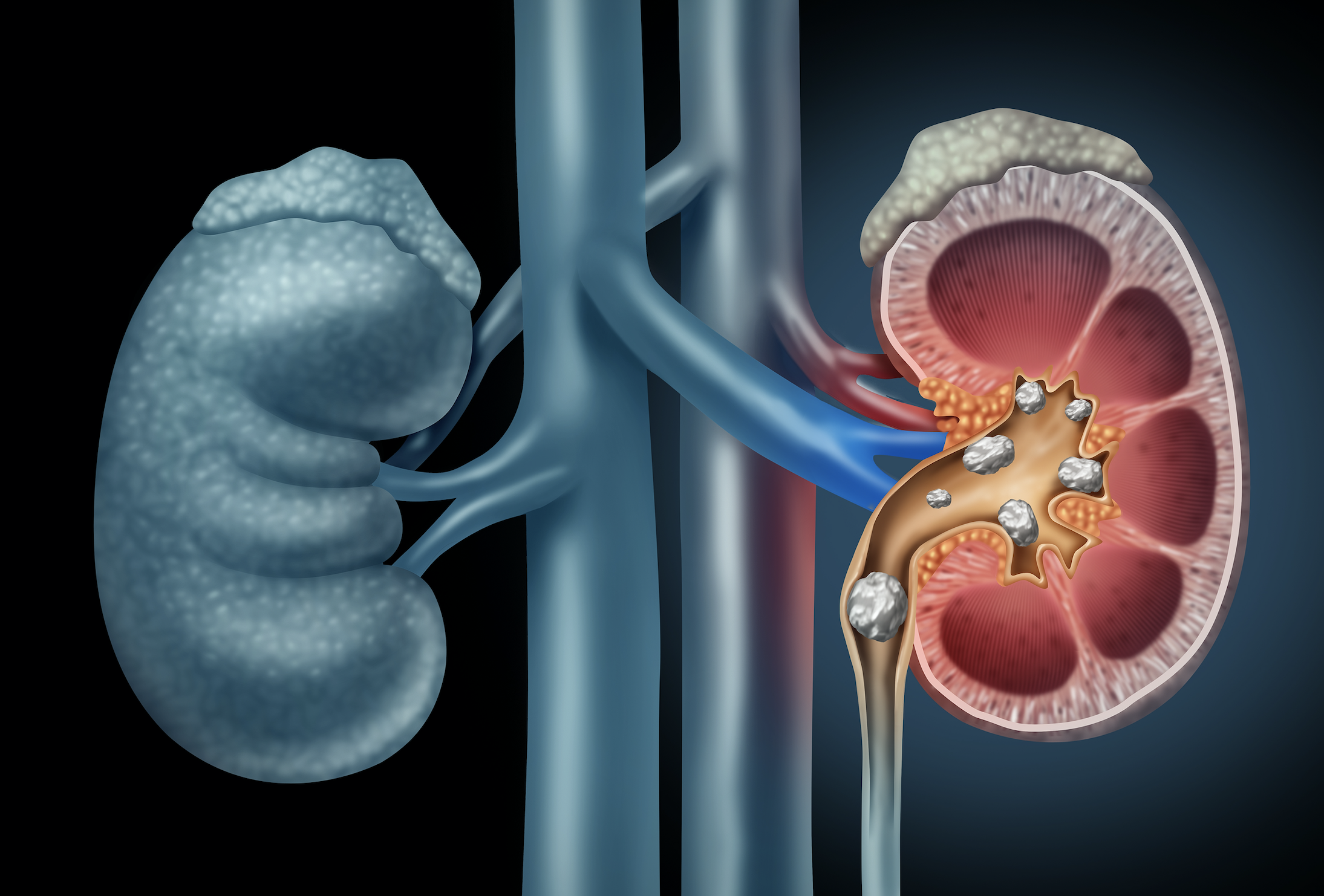 Kidney Stones - Matthew Mutter MD