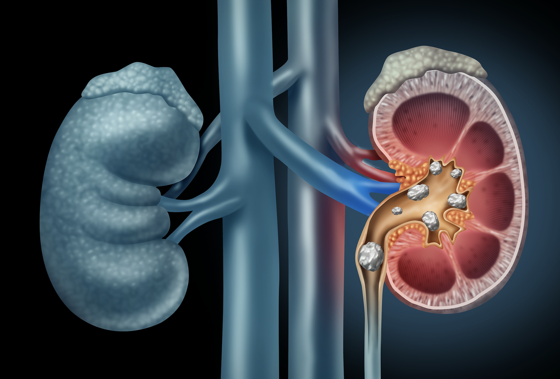 kidney-stones-matthew-mutter-md